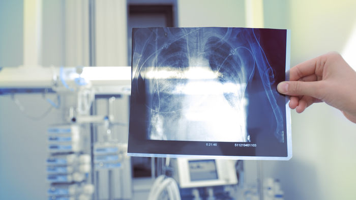 COPD: Wenn Atemnot zum Alltag gehört